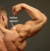 Arm lift 'hollow'